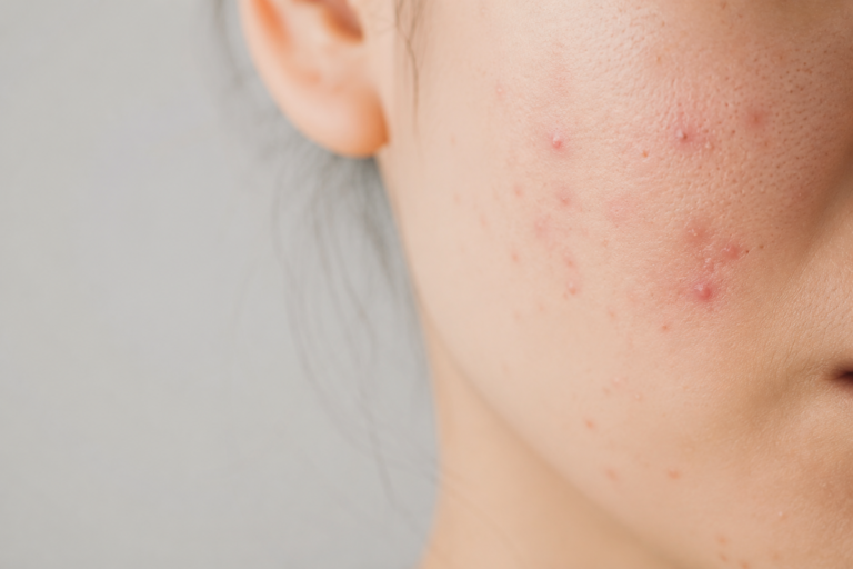 Acne: muito além da pele oleosa